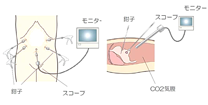 図1 腹腔鏡下手術