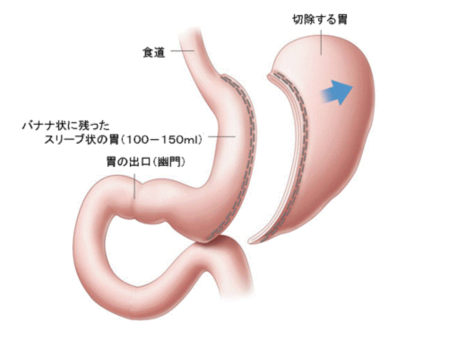 図1：胃スリーブ切除