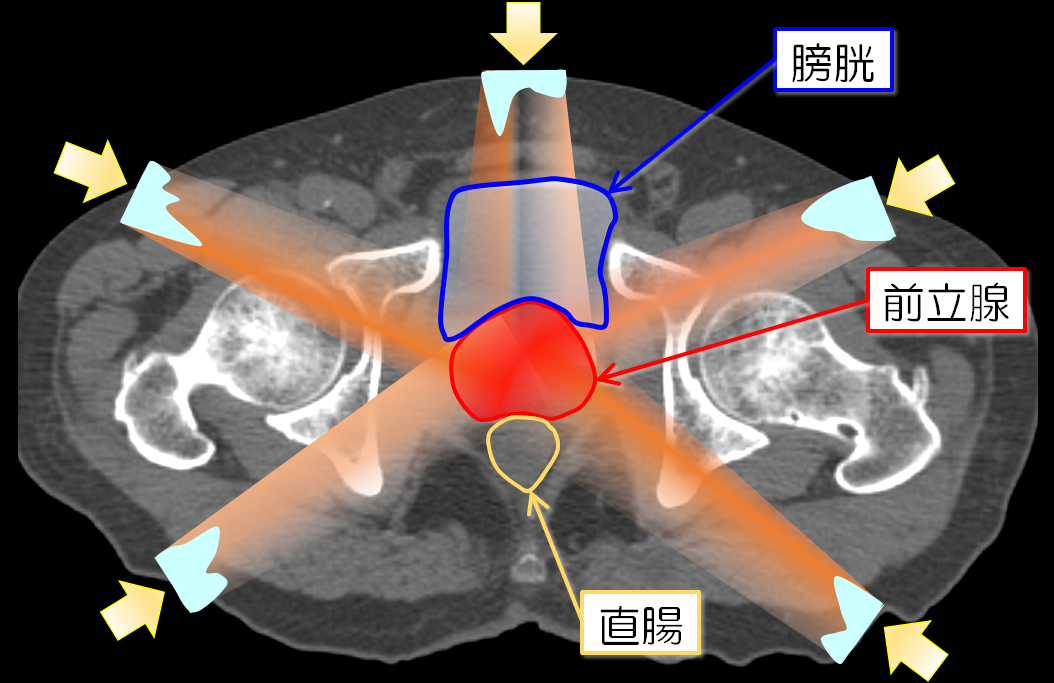 図1. IMRTの原理